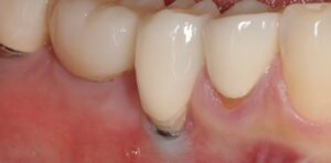 Scopri di più sull'articolo PERI-IMPLANTITE E PERDITA OSSEA IMPLANTARE